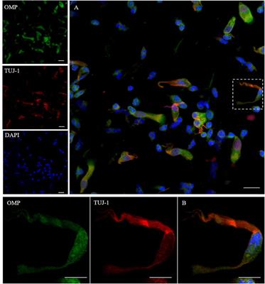 Neurodegeneration-Associated Proteins in Human Olfactory Neurons Collected by Nasal Brushing